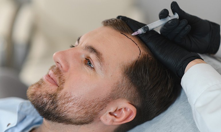 Hair Transplant